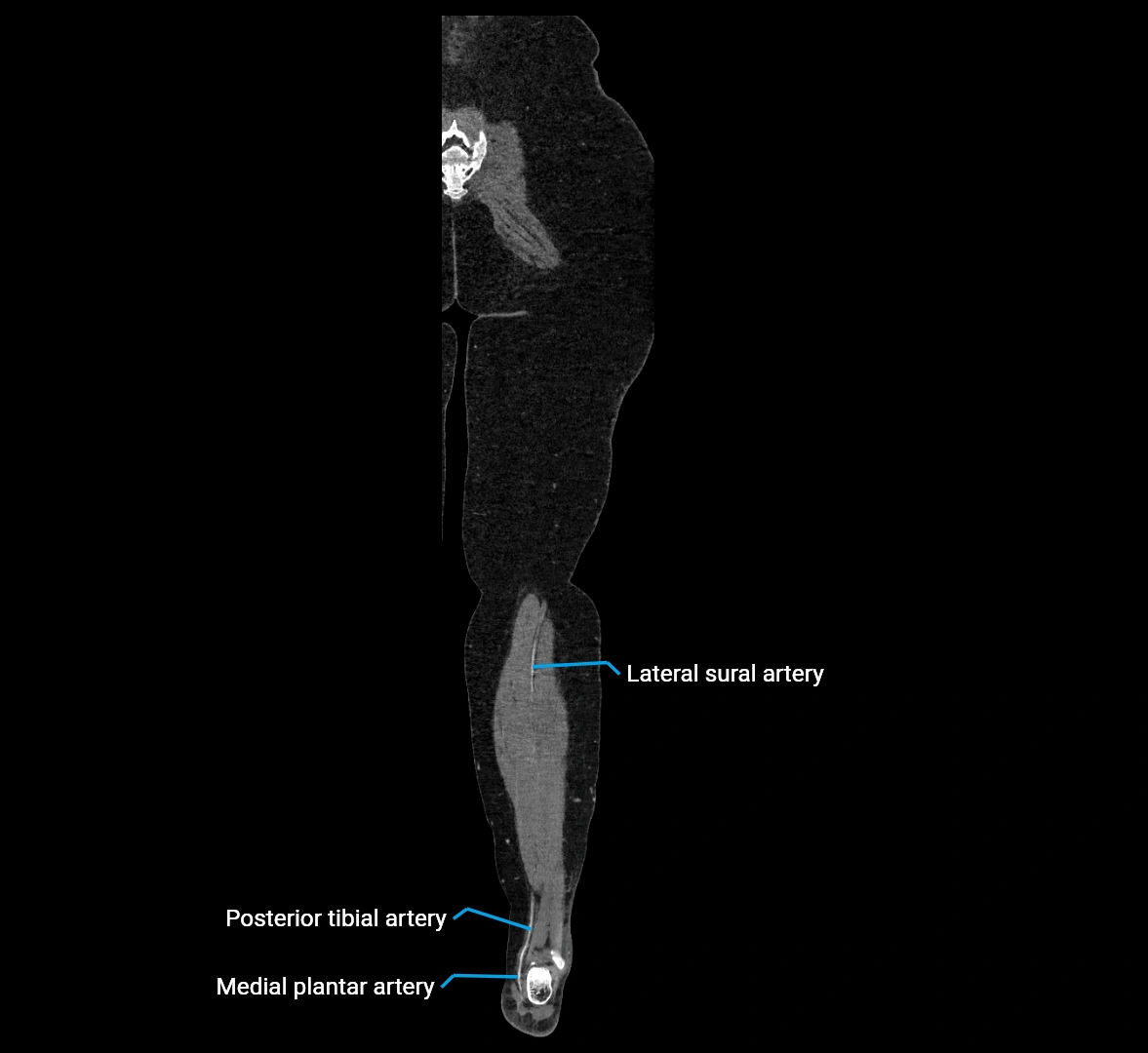 CTA lower limb coronal cross sectional anatomy labelled image _79 (2).webp